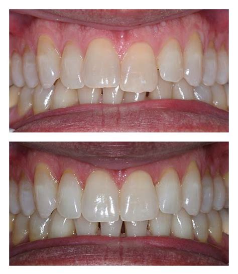 Clear Braces Before And After Bartholomew Dentist