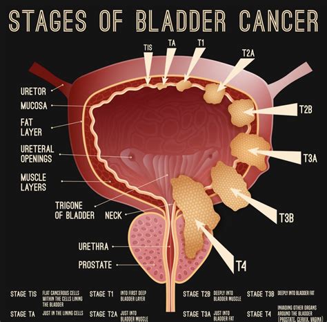 bladder cancer africa cancer hub