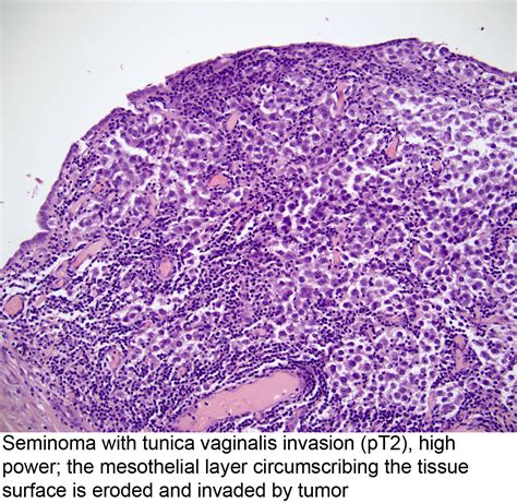 pathology outlines pathologic tnm staging of testis germ cell tumor