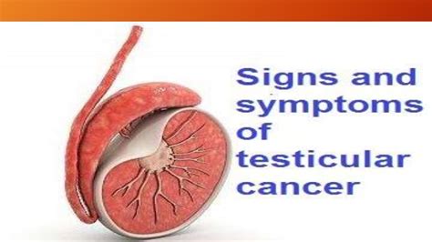 what causes testicular cancer cancer oz