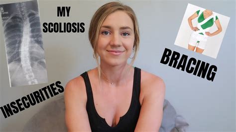 My Scoliosis Story Youtube