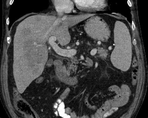 Liver Atlas Diagnosis Lymphoma