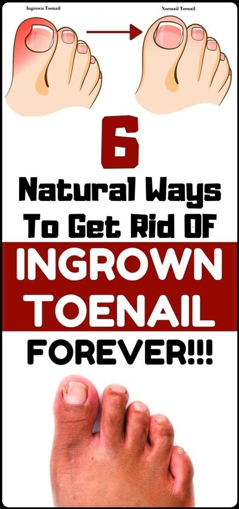 solve  ingrown toenail    natural homemade remedies
