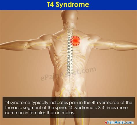 T4 Syndrome Thoracic Outlet Syndrome Symptoms Massage
