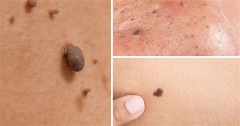here s how to naturally cure age spots moles skin tags