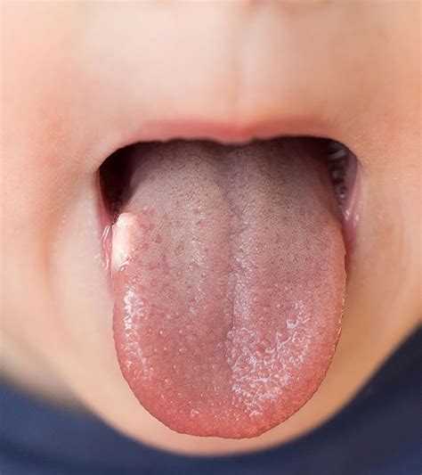 bumps   tongue heres     tongue health lie bumps