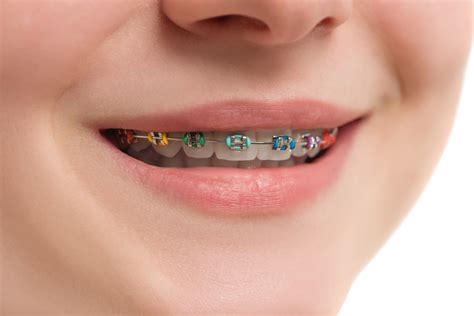 closeup multicolored braces  teeth beautiful female smile   ligating braces