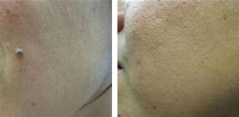 Mole Removal In Boston Skinsational By Dr Luciano