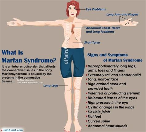 What Is Marfan Syndrome Marfan Syndrome Osteoporosis
