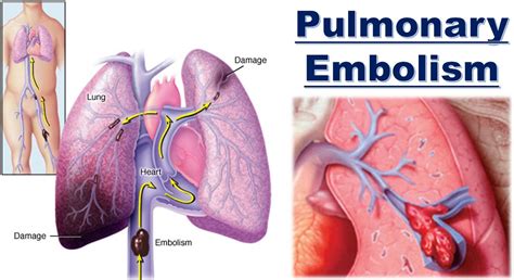 What Is Pulmonary Embolism Causes Symptoms Treatment And Prevention