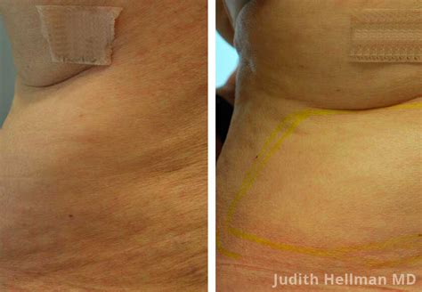 non surgical fat removal photos before and after nyc