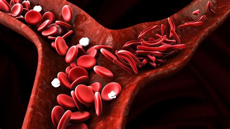 sickle cell anemia  symptoms  treatment  amino company