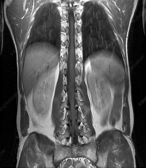 Normal Spinal Cord Mri Stock Image C026 7927 Science Photo Library