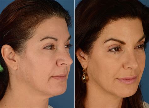 revision rhinoplasty photos page 2 of 3 aesthetic