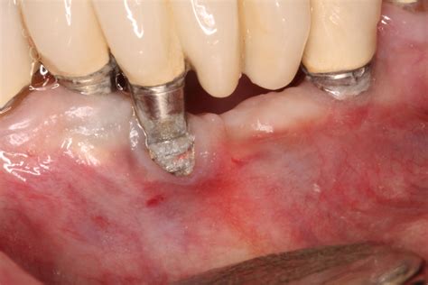 dental implant confidential ryan lanman dds msd