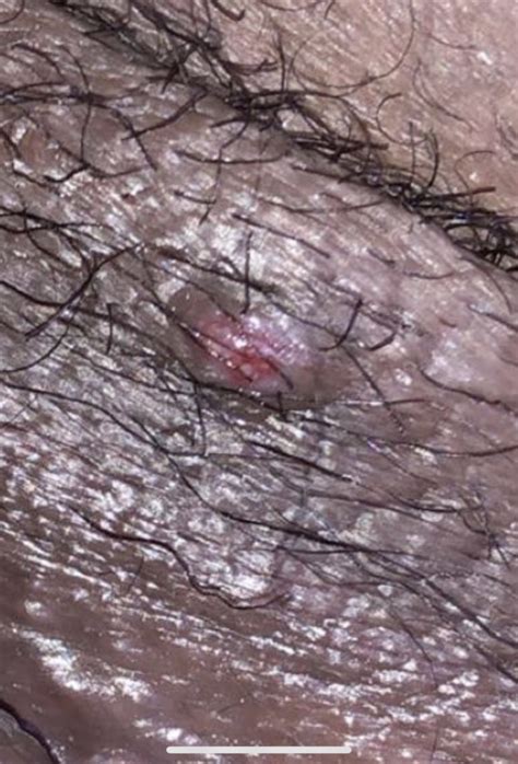 bump near vagina help please [warning graphic image