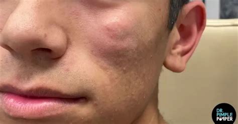 dr pimple popper   massive face cyst explode green liquid   patients eye