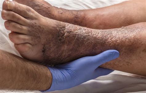 stasis dermatitis  ulcers  symptoms  treatment