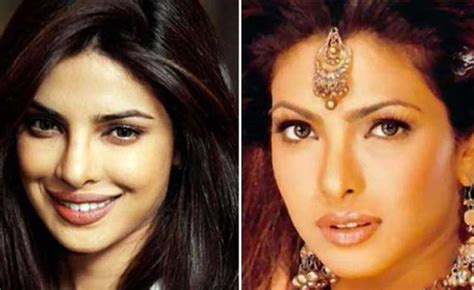 Priyanka Chopra Plastic Surgery Nose Job Lip Fillers Botox