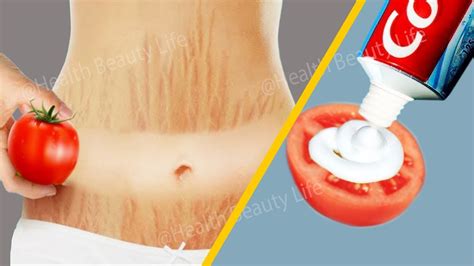 How To Get Rid Stretch Marks Fast Naturally And Permanently At Home