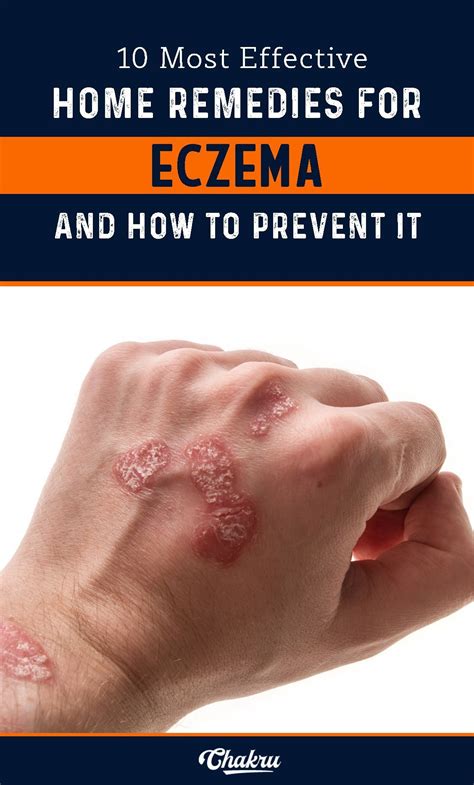 home remedies  eczema    prevent  completely home