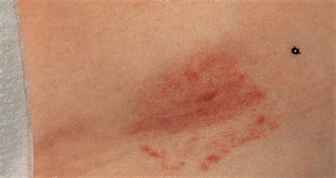 Physician Diagnosed Erythema Migrans And Erythema Migrans Like Rashes