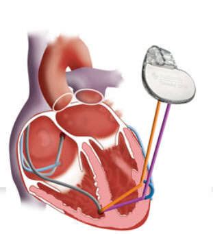 crt pacemaker crt p market   growth analysis  boston scientific medtronic st