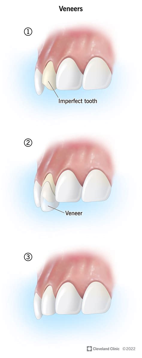 veneers   dental veneers cost procedure advantages