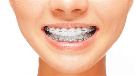 naylors court dental partners blog facts  braces