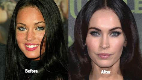 53 Celebrity Plastic Surgery Gone Wrong Before And After