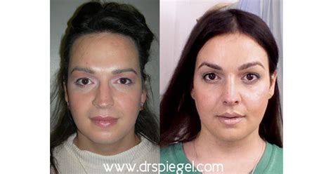 9 Sex Reassignment Surgery A Transgender Woman Who Is