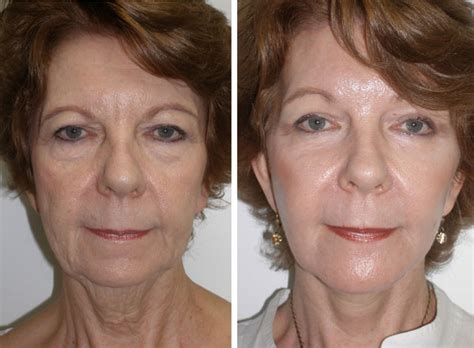cheek implants gallery richmond va cosmetic facial surgery