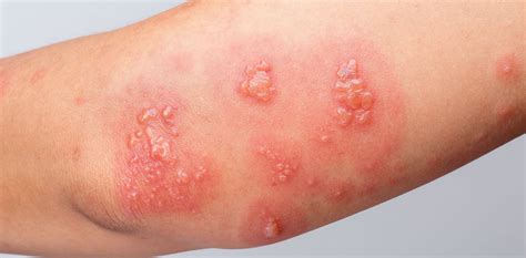 skin infections treatments sagebrush dermatology