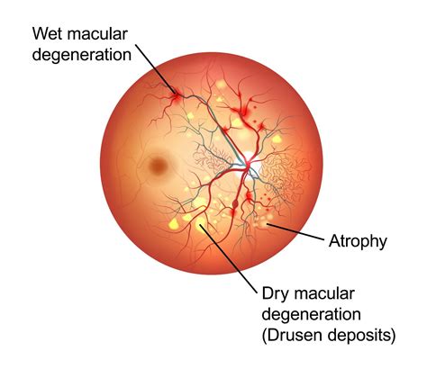 macular degeneration treatment mandeville la