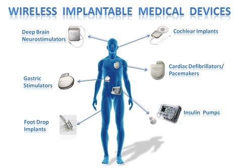 wireless implantable medical devices links  examples