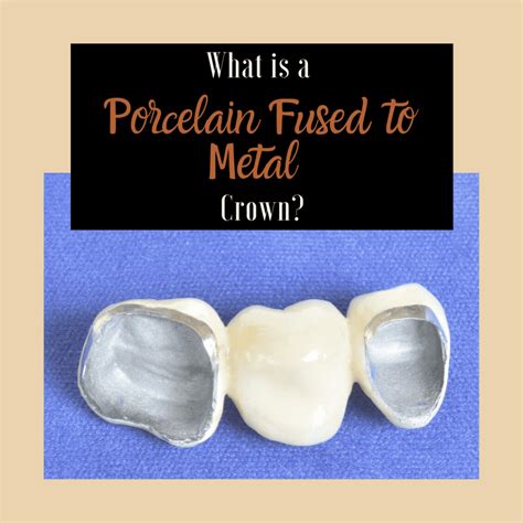 porcelain fused  metal crown pasha dental