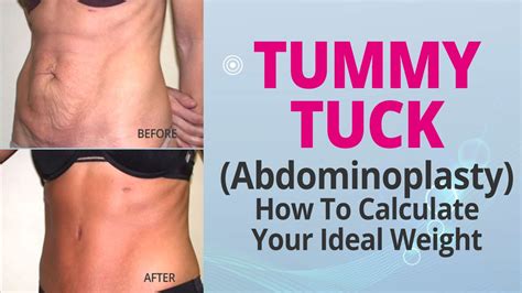how to calculate your ideal weight for a tummy tuck abdominoplasty youtube