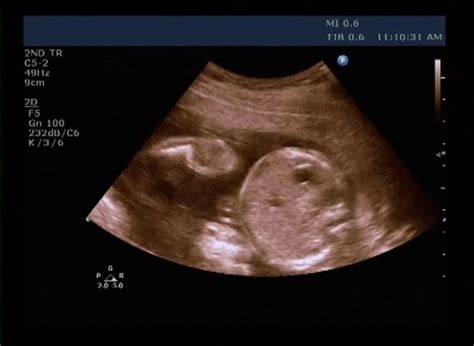 medical ultrasound scan of human embryo measurements of the size of the head stock footage