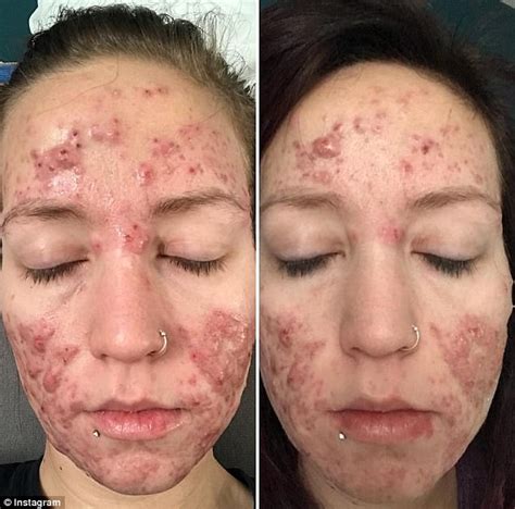manitoba woman shares her battle against severe acne daily mail online