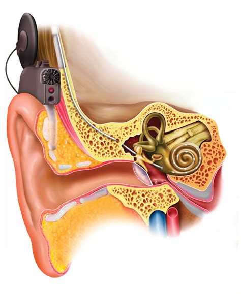 cochlear implant programme auditory implant service