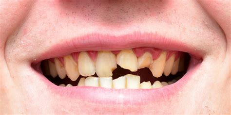 oral health  olympic athletes  awful teeth