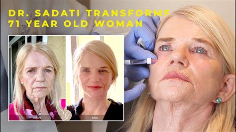 Dr Sadati Transforms 71 Year Old Woman With Lower Face And Neck Lift