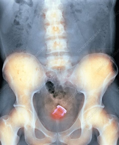 Drinks Bottle In Mans Rectum X Ray Stock Image C007 6061