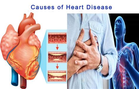 heart disease definition symptoms  risk factors