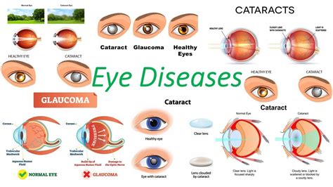 Eye Diseases Youtube