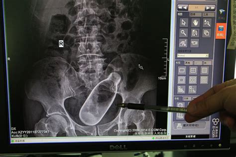 Shocking Hospital X Ray Shows Man With Bottle Stuck Inside Him