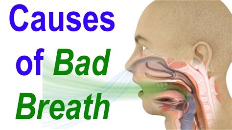 sources of bad breath or halitosis evaluate diagnose and treat youtube
