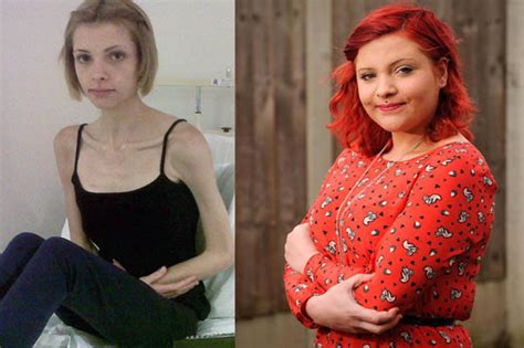 anorexic girl who weighed four stone nearly died after nhs let her down