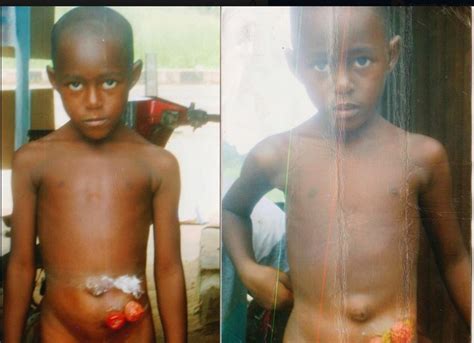Favour Lawal Girl Born Without Anus Who Excretes Through