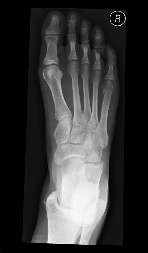 Neck Of The 5th Metatarsal Fracture Image